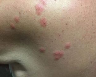 Woman suffers 200 bed bug bites in London hotel