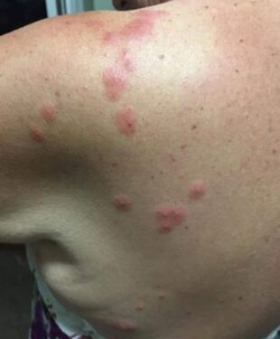 Woman suffers 200 bed bug bites in London hotel
