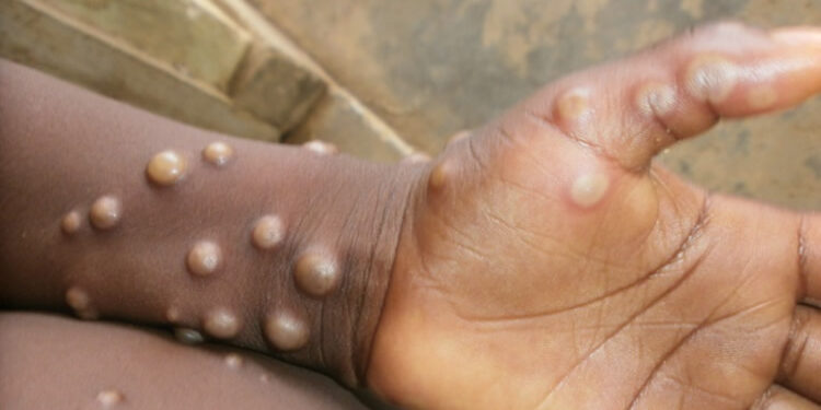 MPOX:  Rivers,8 other states put on high alert